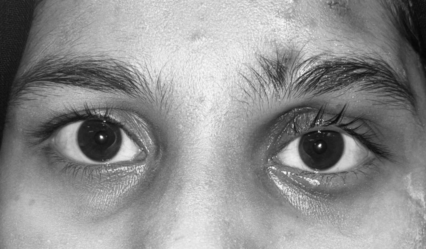 Successful Ptosis Correction (Eyelid Surgery) showing restored eyelid height and natural symmetry by Dr. Saumika Singh