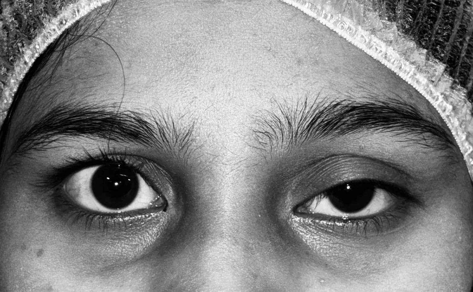 Pre-operative photograph showing congenital ptosis of the left upper eyelid